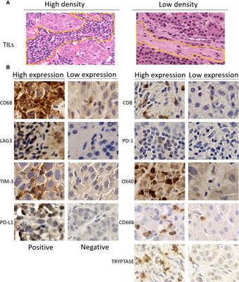 Immune-Related Biomarkers Improve Performance of Risk Prediction Models for Survival in Patients With Hepatocellular Carcinoma